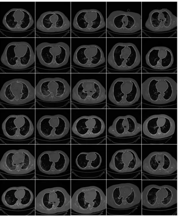 Figure 3. Raw lung images with ground truth boundary (white) overlay on grayscale CT scans.