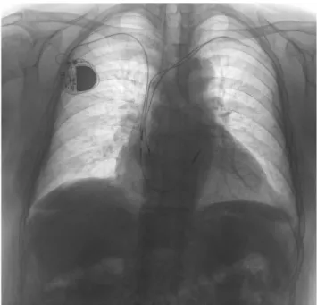 Fig. 3 Preoperative chest X-ray of a 74-year-old male having two, 8- 8-year-old, passive fixation, truncated, and highly disintegrated leads beside his new VVI pacemaker system implanted from the right side