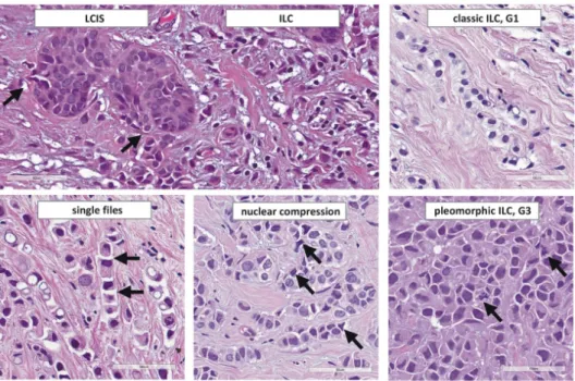 Figure 2. Histomorphology of ILC. From top left to lower right, photomicrographs (×400 magnification) illustrate: transi- transi-tion from LCIS to ILC (arrows indicate LCIS cells that breach through the basal lamina), classical ILC (G1), ILC arranged  in s