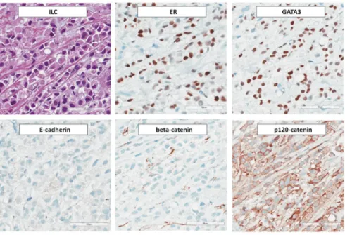 Figure 3. Immunohistochemical features of ILC. From Photomicrographs (×200 magnification) illustrate: expression of ER  and GATA3, loss of E-cadherin and β-catenin, and aberrant cytoplasmic localization of p120-catenin
