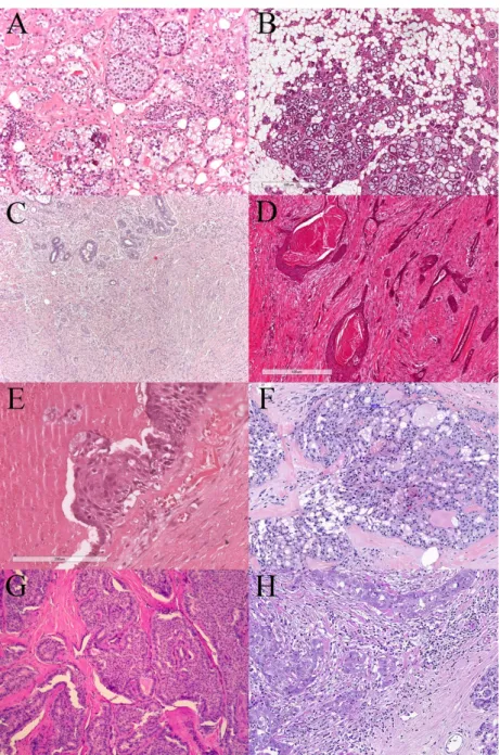 Figure 1. Heterogeneity of triple negative breast cancers. (A) Low magnification view of acinic cell  carcinoma (ACC) with microglandular architecture composed of small glands, tightly packed  to-gether