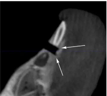 Fig. 5. The characteristic mark that the trephine leaves in the bone. The serrated work- work-ing end makes a circular cut that surrounds a small piece of unreduced bone