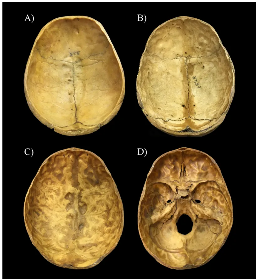Fig 1. Reference cases selected for the classification of individuals exhibiting APDIs on the endocranial surface of the skull