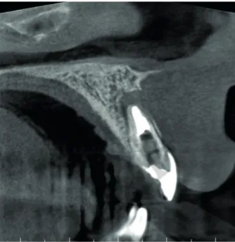 Figure 3. Cone-beam computed tomography image after the establishment of the apical mineral trioxide  aggregate plug.