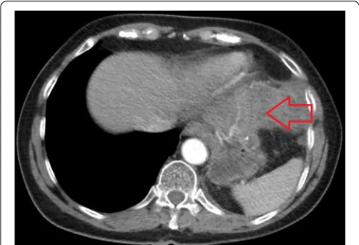 Fig. 2  Preoperative cross-sectional CT image of the tumor (red  arrow)