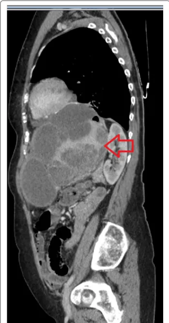 Fig. 7  CT-sagittal view of recurrent tumor at the site of the spleen,  3 year after surgery (red arrow)
