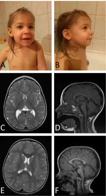 Fig. 1. Photos and MR images of the patient. The patient at the age of 2.5 years (A and B)