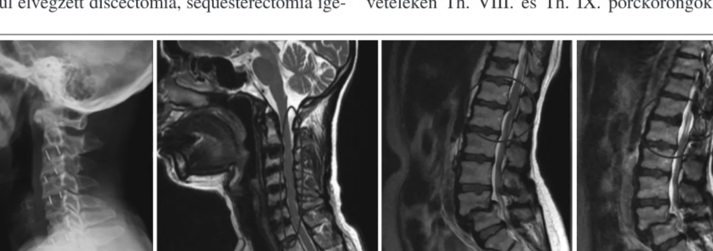 1. ábra. Az oldalirányú nyakigerinc-röntgenfelvételeken CII-tôl CVI-ig végzett discectomiák és a megfelelô helyzet- helyzet-ben ábrázolódó cage implantátumok láthatók (A), a nyílirányú nyakigerinc-MRI-felvételen a felszabadított nyaki gerincvelô látható vi
