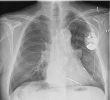 Fig. 1 9 Chest X-ray after  implan-tation of a cardiac resynchronization therapy with  de-fibrillator system with epicardial left ventricular lead ular node ablation was performed due toatrial ﬁbrillation refractory to pharmaco-logical treatment and sympto