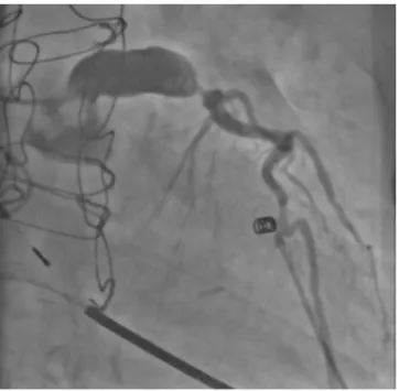 Fig. 3 9 Coronary angiogram showing a left main  coro-nary aneurysm and subtotal occlusion of the left  ante-rior descending artery (right  ante-rior oblique 14°, caudal 15°)