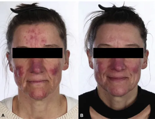 Fig 5. Rosacea. Photographs of a female subject in the ivermectin 1% cream (IVM) and doxycycline 40-mg modified-release capsules (DMR) treatment arm at baseline with 66 inflammatory lesions, an Investigator’s Global Assessment (IGA) score of 4, and a Clini