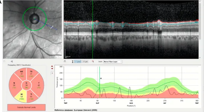 Figure 4 (A) Preoperative OCT image of a 62-year-old male patient displaying signiﬁcantly reduced RNFLT in all except for the inferonasal sector