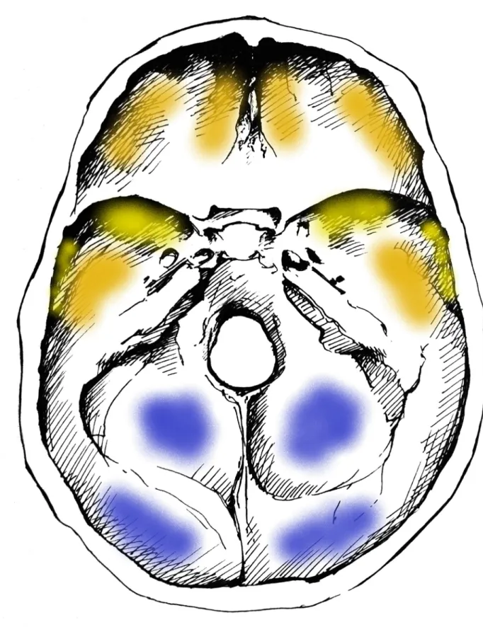 Fig 1. Typical localizations of GIs on the inner surface of the skull base. Blue: most commonly affected areas, orange: commonly affected areas, and yellow: less commonly affected areas (drawing by Luca Kis).