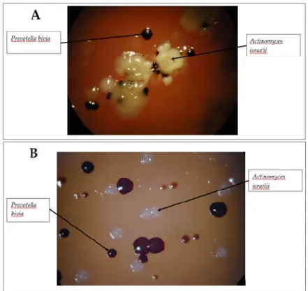 Figure 1. Culture results of the sample taken in Case 1. A: Colonies observed on anaerobic blood agar  after 5 days of incubation B: Colonies observed on anaerobic blood agar after 7 days of incubation  (courtesy of Gabriella Terhes PhD, University of Szeg
