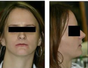 Fig 1: The patient's face and profile, characterized by the distinctive  features of the disease (before dental treatment)