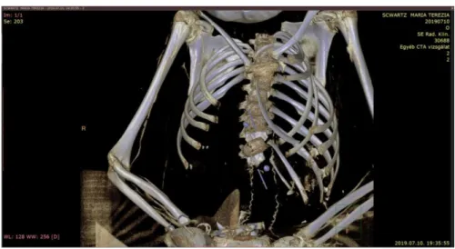 2. ábra: A mellkas 3D rekonstrukciója (felvétel: Radiológia Klinika, Semmelweis Egyetem)