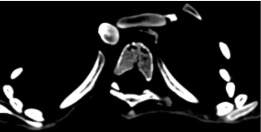 4. ábra: A basivertebrális véna körüli nagyobb kiterjedésű hypodens területek (felvétel: Radiológia  Klinika, Semmelweis Egyetem)