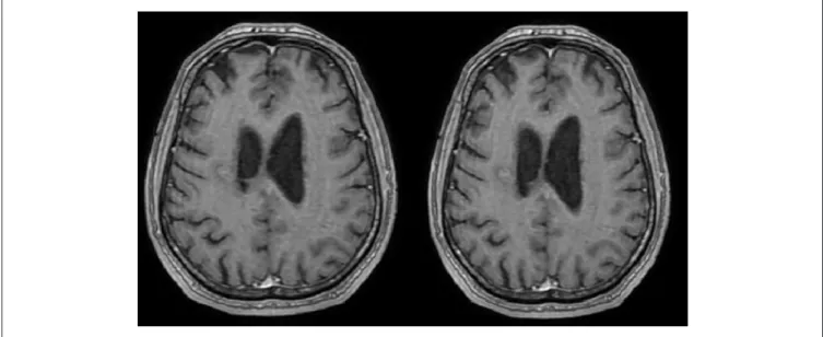 Figure 6.  The contrast-enhanced magnetic resonance imaging scans after 1 year show a complete regression of the lesion on the left  side