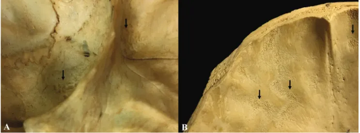Figure 2. Examples of TBM associated lesions. A: Granular impressions on the greater wing of the sphenoid bone (Robert J