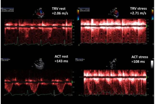 Figure 2 presents TRV and ACT rest and stress measure- measure-ments done in healthy 43-old-year female whereas in Fig. 3  respective parameters are displayed in 63-year-old man with  diagnosed pulmonary hypertension