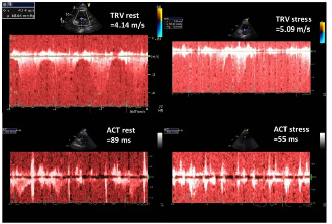 Fig. 3    Graphic presentation of TRV and ACT measurements at baseline and peak stress in 63-year-old man with poor exercise tolerance and  highly abnormal PVRI, calculated as the ratio of ESE time and ΔSPAP in tens; PVRI = 3 min/3.5 = 0.9