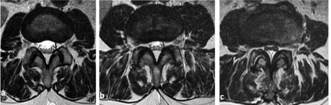 Fig. 2. Thoracolumbar spine MRI STIR examination. The arrow shows the compression fracture of the L.I