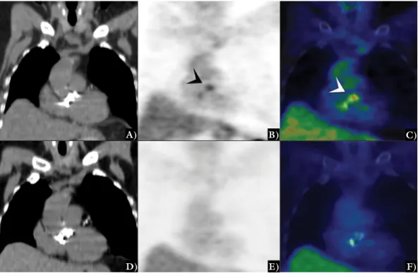 2. ábra 18 F-FDG-PET/CT-vel igazolt infektív műbillentyű-endocarditis. Kardiológiai előkészítés után műbillentyű-endocarditis gyanúja miatt végzett 