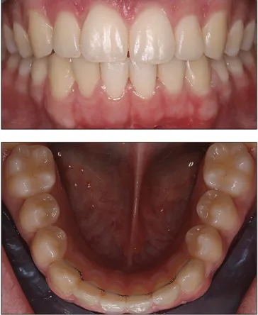 7. kép:  A fogszabályozás végére elért állapot   front- és okkluzális nézetből.  