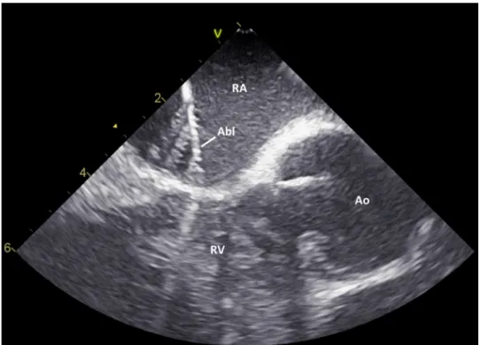 Fig. 1    Direct visualization of  the ablation catheter in the slow  pathway region by intracardiac  echocardiography (ICE)