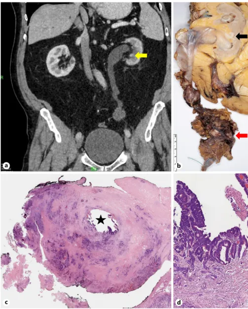Fig. 1.  Radiological and pathological features  of the case presented.  a  Axial enhanced  ab-dominal CT scan (soft tissue window) shows  an inhomogeneous, contrast-enhanced,  lobulated lesion (30 × 41 × 32 mm) in the low  third segment of the left ureter