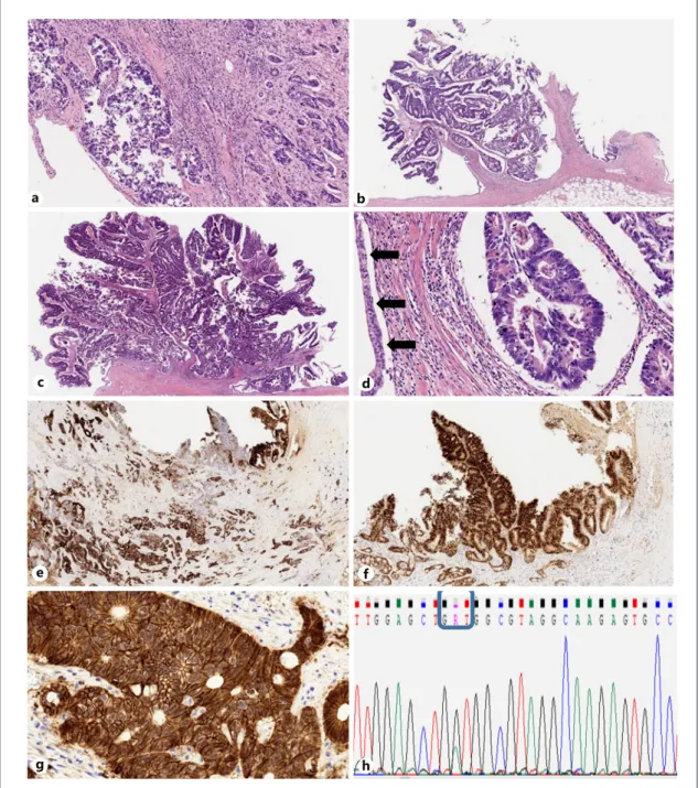Fig. 2.  Histological, immunohistochemical, and genetic features  observed.  a  This renal pelvis metastasis has a flat appearance along  with the invasion of the adjacent renal parenchyma
