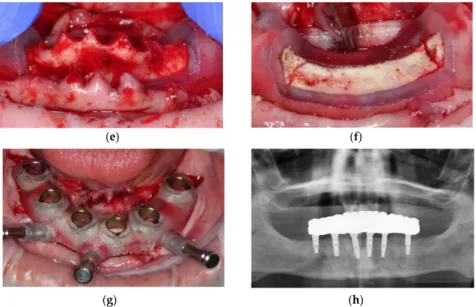 Figure 2. Example of a case using bone reduction guide: (a) Pretreatment clinical situation