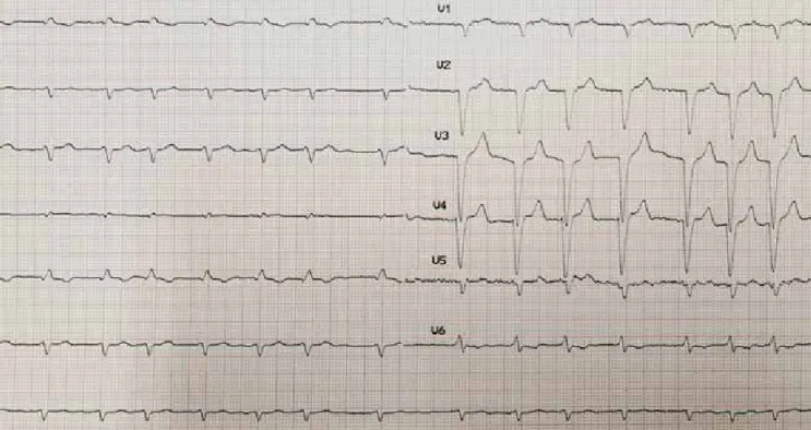 1. ÁBRA. A beteg 12 elvezetéses EKG-felvétele, amely normofrekvens pitvarfibrillációt, bal Tawara-szár-blokkot, végtagi elvezetésekben  low voltage-t mutat
