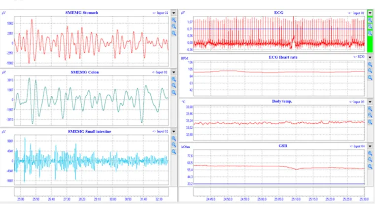 Fig. 5. The signals of ECG and SMEMG measurements in healthy volunteers (Study 2). The SMEMG signals of 3 GI tract segments are shown online on the left side,  while ECG, HR and BT can be seen together with the GSR data on the right side