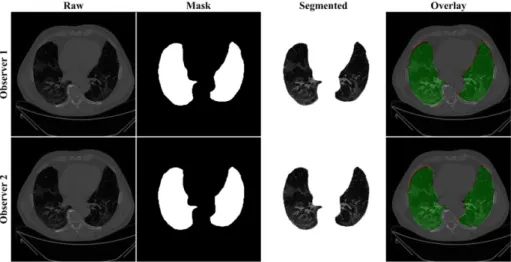 study, i.e., a binary mask of the segmented lungs. Figure 7, Figure 8 and Figure 9 show  the AI-generated binary mask, segmented lung, and color segmented lung with grayscale  background as an overlay for the three AI models