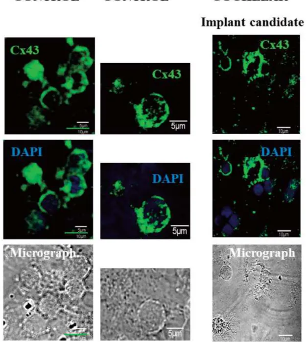 Fig. 3B. The level of Cx43 ion channel protein decreased in hearing loss patient. The connexin 26 (Cx43) pro- pro-tein was labeled with green dye and nucleus with 2,4-diamino-2-phenylindole (DAPI, blue)