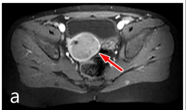 FIGURE 1 | MRI image of the uterine lesion.