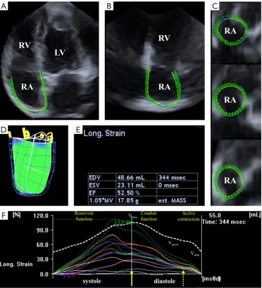 Figure 1 Apical four-chamber (A) and two-chamber views (B) as well as short-axis views at the basal (C1), mid- (C2), and superior (C3)  right atrial level derived from an active acromegaly patient’s three-dimensional echocardiographic dataset