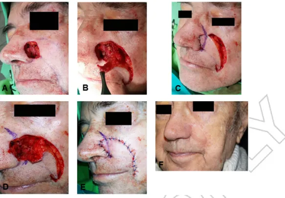 FIGURE 1 Different steps of the operation. A: preoperative status, B: dissection of the subcutaneous and cutaneous pedicled flap, C: temporarily situated flap, blue ink shows the position of alar-facial groove on the skin flap, D: alar-facial groove is fix