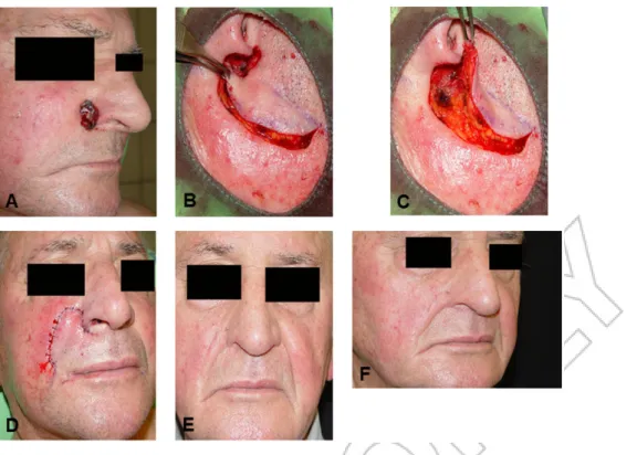 FIGURE 2 Reconstruction in another patient. A: preoperative status, B: preparation of the flap, C: positioning of the flap, D:
