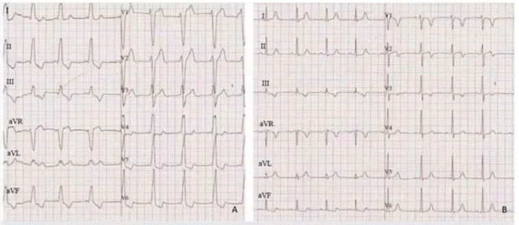 5. ÁBRA. Az ablációt megelőző (A) és azt követő (B) testfelszíni  12 elvezetéses EKG
