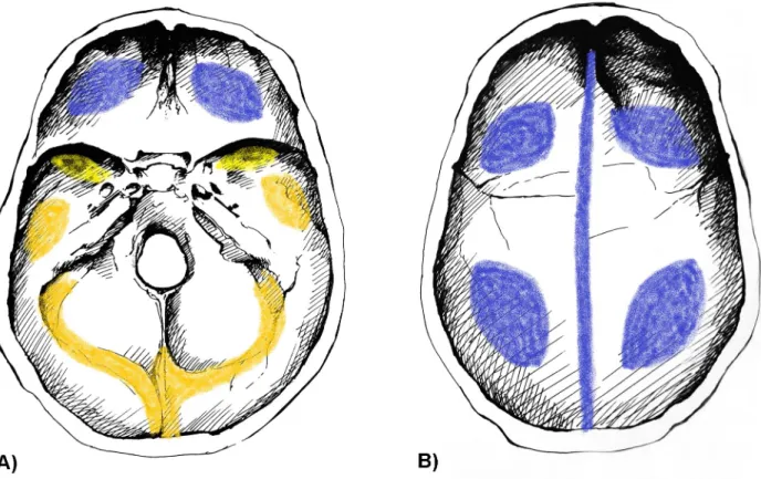Fig 7. Typical localizations of PAs on the inner surface of the A) skull base and B) skullcap