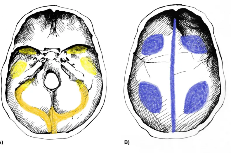 Fig 2. Typical localizations of ABVIs on the inner surface of the A) skull base and B) skullcap