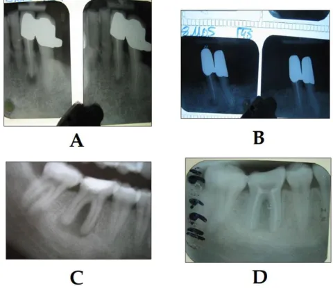 Figure 5. Success of PDT in the treatment of chronic periapical periodontitis (photo courtesy of R