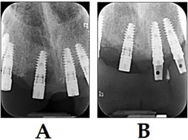 Figure 7. Treatment of patients with peri-implantitis with PDT and BIOOSS bone graft material (photo  courtesy  of  R