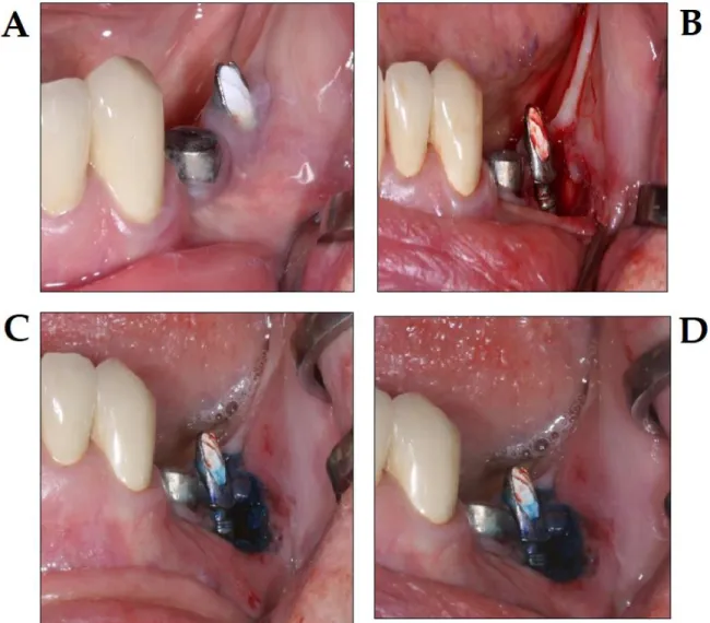 Figure 8. PDT in the treatment of periimplantitis, using the Photolase ®  PDT system (photo courtesy  of Z