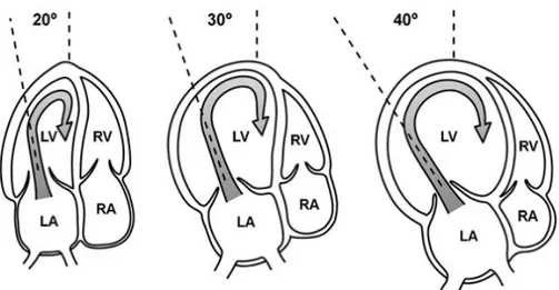 Şekil  5.  Normal  ve  dilate  bir  kalpte  mitral  giriş  akımı  ölçümü  için  transduserin  yerleştirme pozisyonu  
