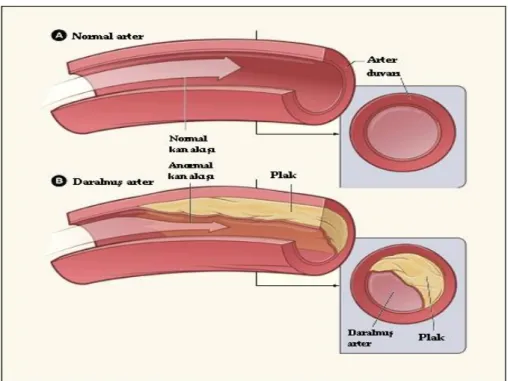 Şekil 10 :  Normal ve plak oluşmuş arterde kan akışının şematik görünümü [47]  Oluşan plağın iki tipi vardır : 