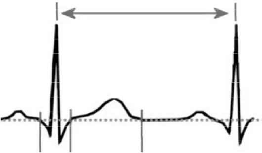 Şekil 10. EKG de QT süresinin şematik gösterilmesi 