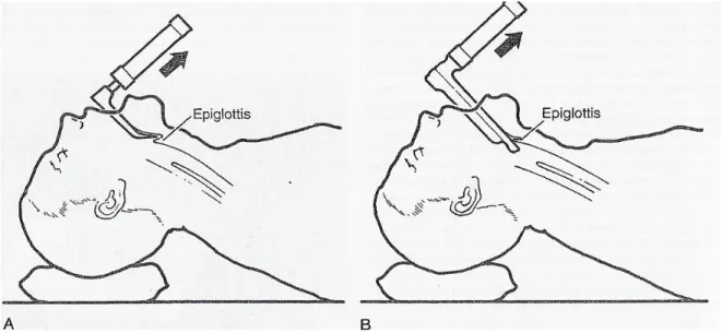 Şekil 3: A: Eğri kaşıklı laringoskop kullanımı B: Düz kaşıklı laringoskop kullanımı 